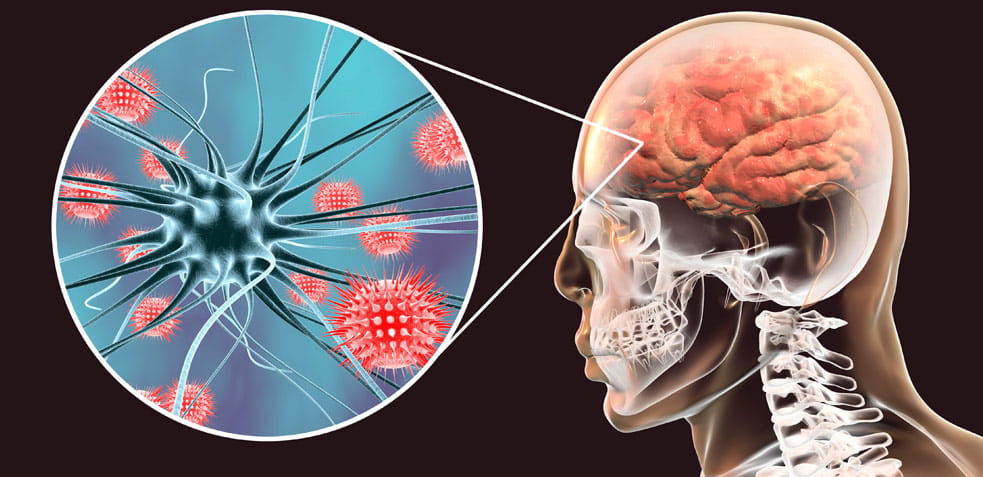 meningitis, una enfermedad que provoca la inflamación y la infección de las meninges