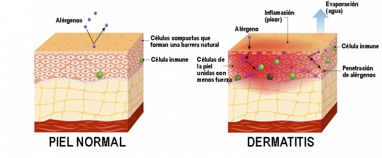 Dermatitis Atópica Causas Prevención Y Tratamiento