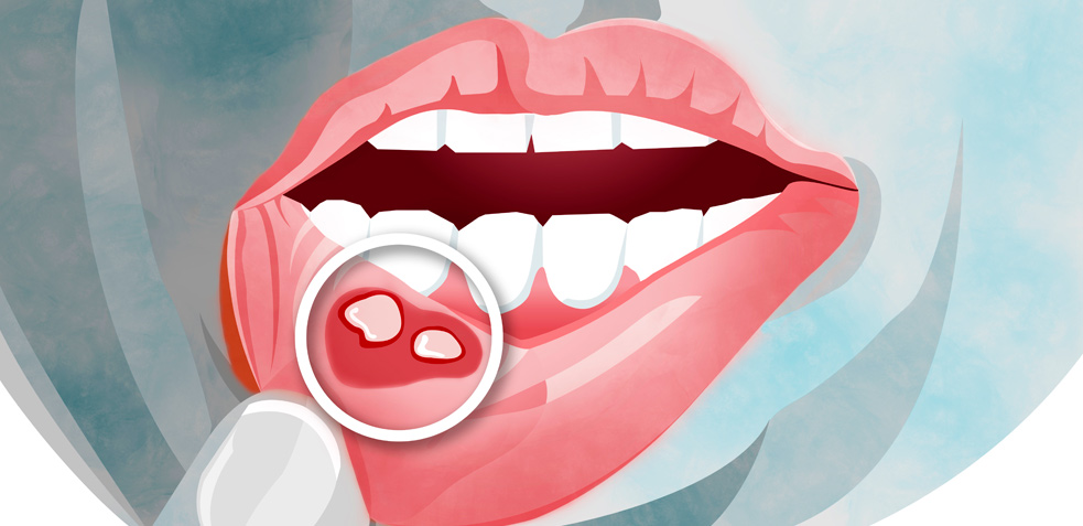 Dibujo de una boca en la que se puede ver una llaga en la parte inferior del labio