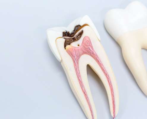 diente dañado necesidad hacer endodoncia