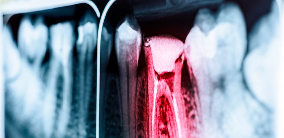 radiografía de una boca mostrando una pieza en mal estado