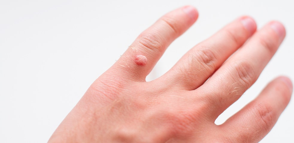 Verruga en el dedo de una mano, son pequeñas lesiones que aparecen en la piel de cualquier lugar del cuerpo