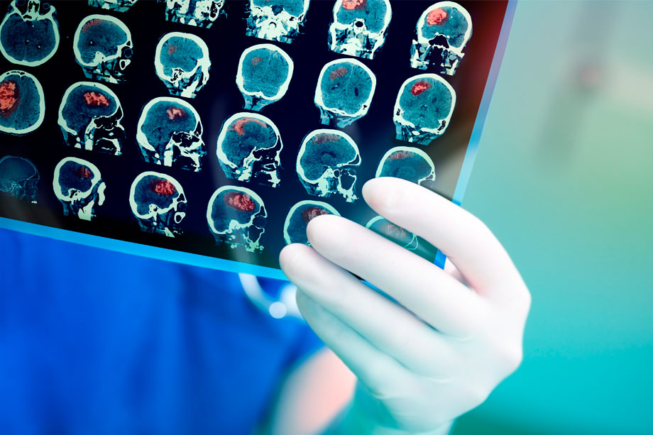 radiografía cerebro ictus