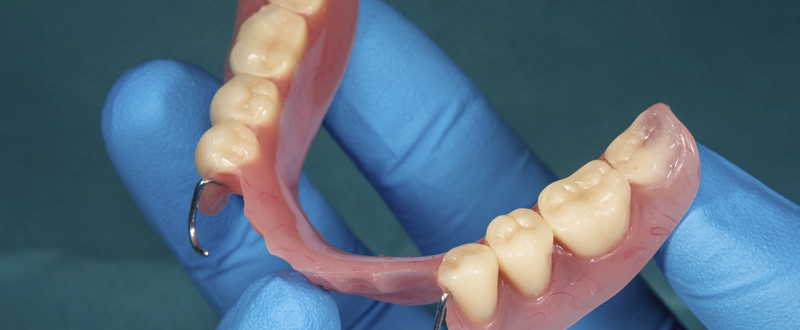 prótesis dental removible