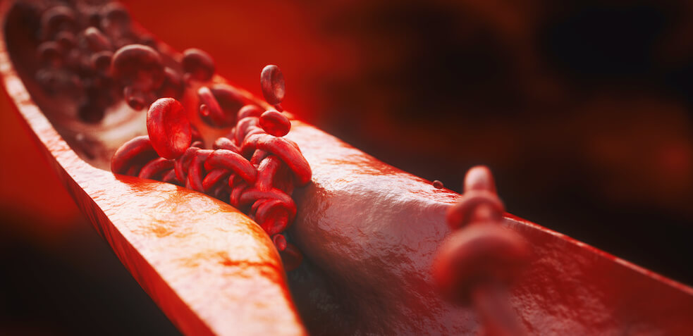 Simulación de un trombo en una arteria