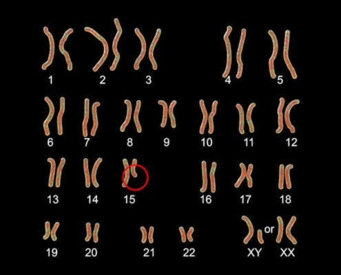 el cromosoma 15 está incompleto en el síndrome de Prader Willi