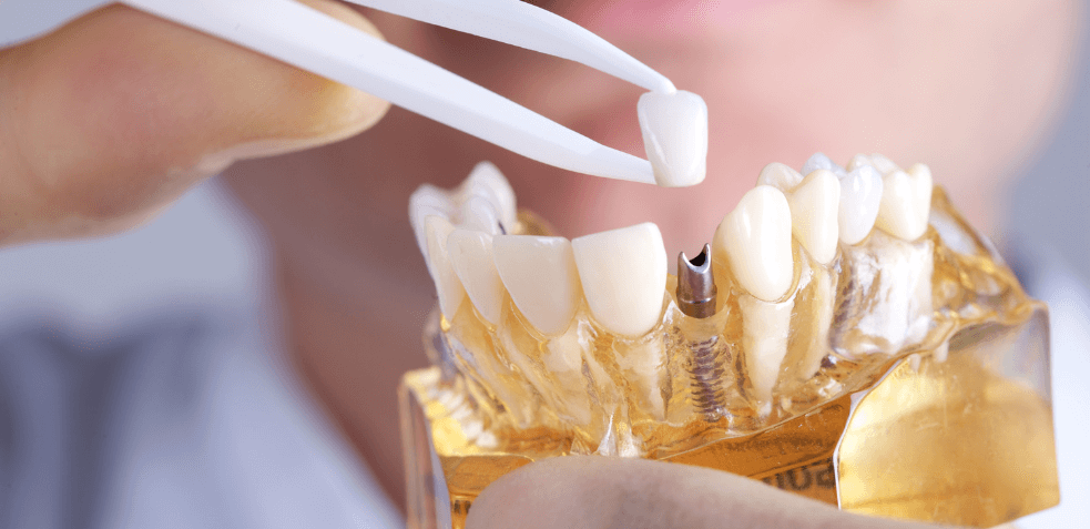 dentista colocando corona dental sobre uno de los tipos de implantes dentales