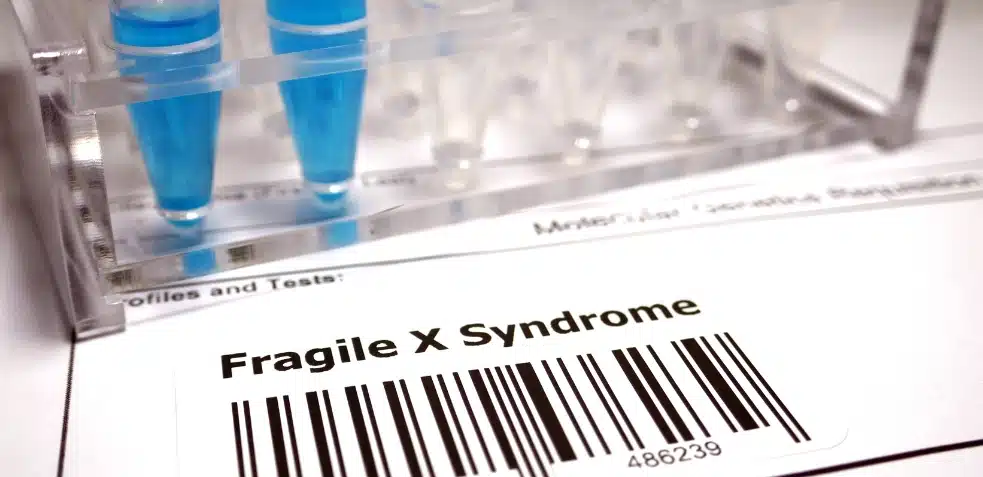 caracteristicas sindrome del cromosoma X fragil en laboratorio