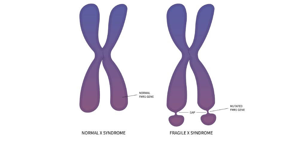 cromosoma x frágil
