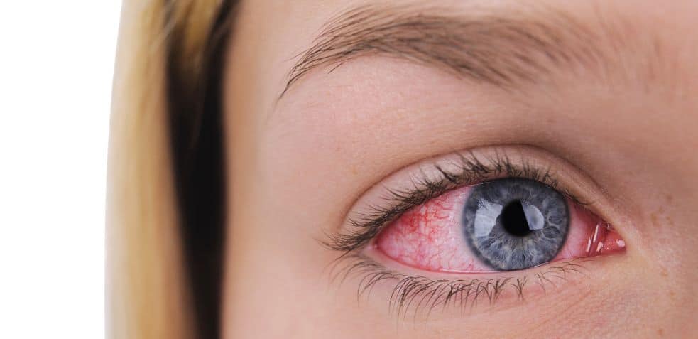 ojo rojo a causa de la resequedad por no consumir alimentos con vitamina a