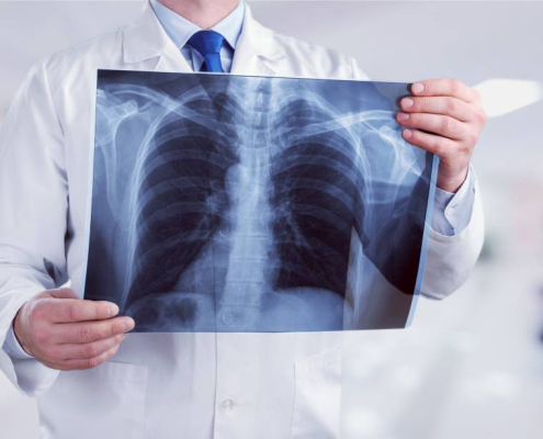 rayos X de pulmones