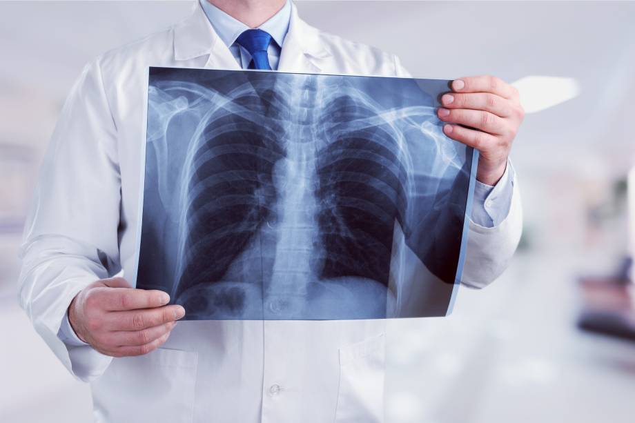 rayos X de pulmones