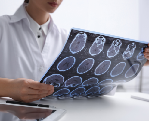 doctor revisando placa tumor cerebral