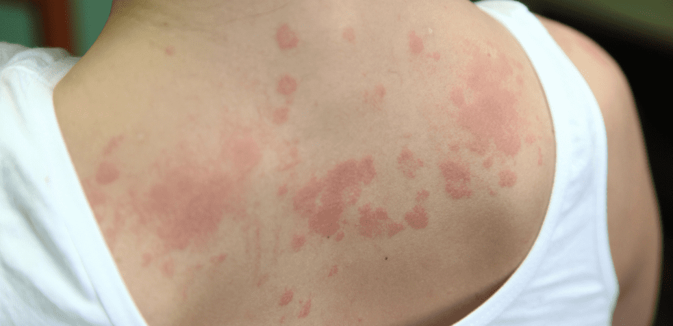 espalda con sintomas de alergia al sol