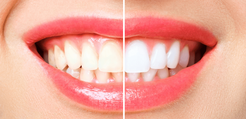boca muestra la diferencia tras aplicar blanqueamiento dental desde casa