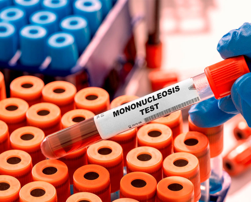 mononucleosis infecciosa