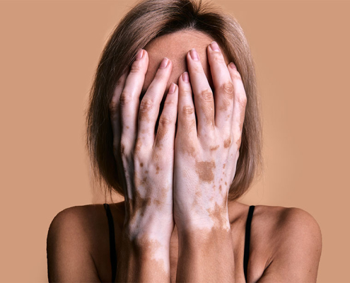 mujer con vitiligo