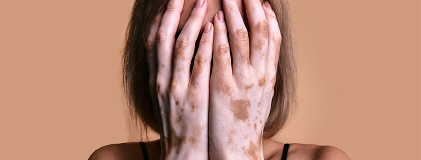 mujer con vitiligo