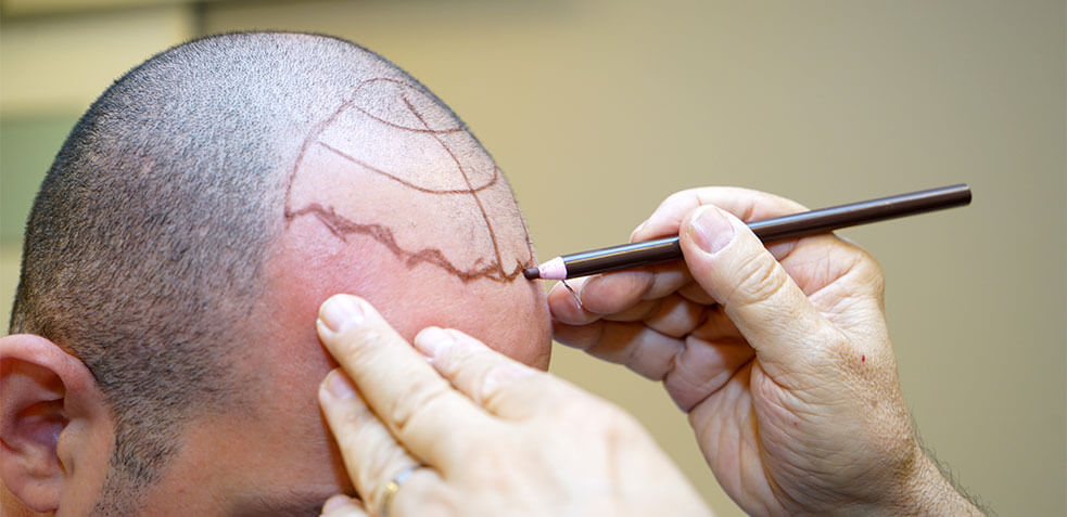 hombre sin pelo es marcado por el médico para trasplante capilar