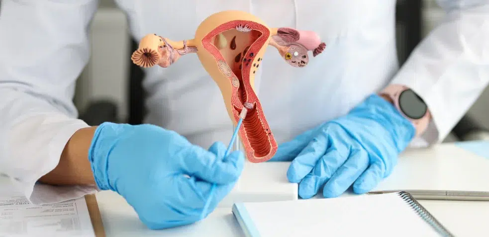 Anatomía de un aparato reproductor femenino con hiperplasia