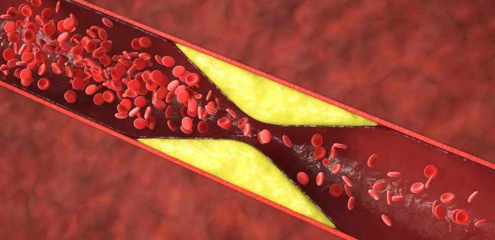 Representación gráfica de colesterol en una vena
