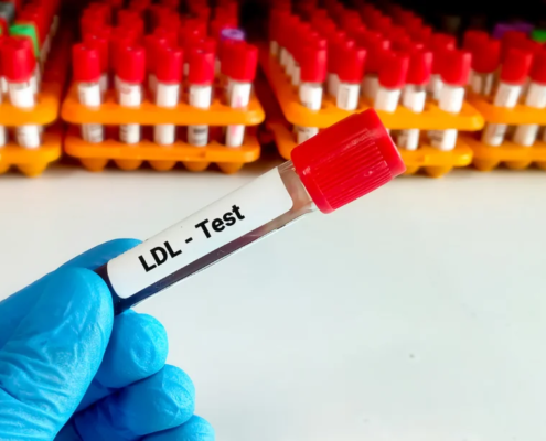Prueba de colesterol LDL en laboratorio