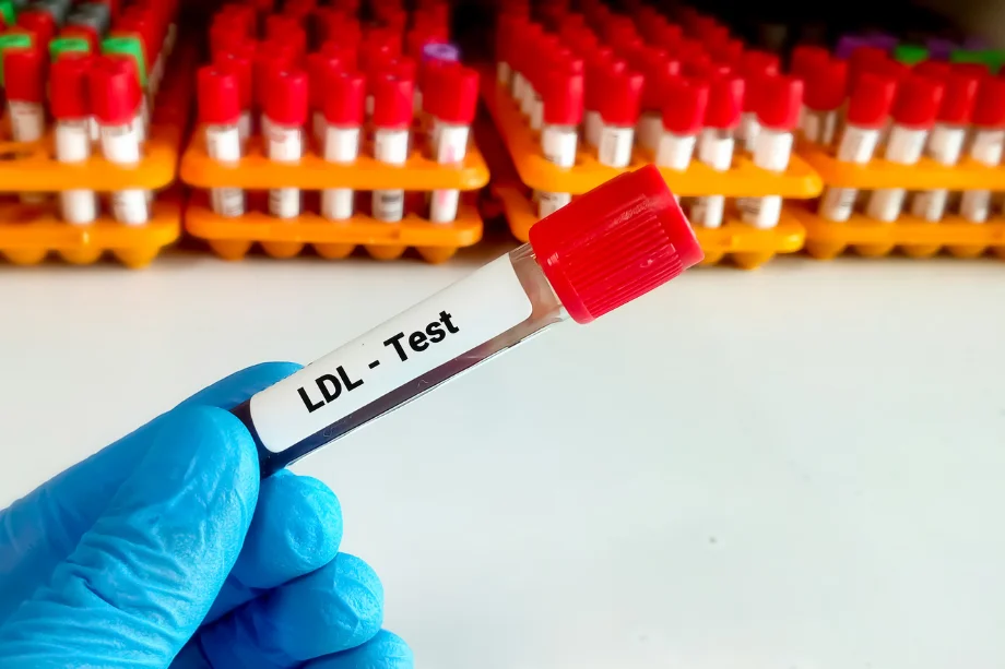 Prueba de colesterol LDL en laboratorio