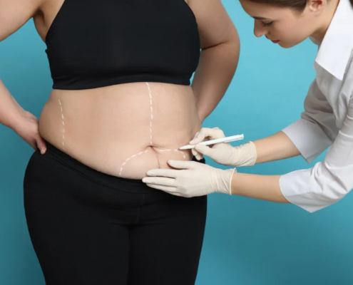 Médico marcando el abdomen de una paciente para una cirugía bariátrica, con líneas guía dibujadas en la piel