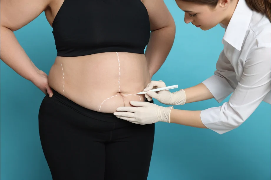 Médico marcando el abdomen de una paciente para una cirugía bariátrica, con líneas guía dibujadas en la piel