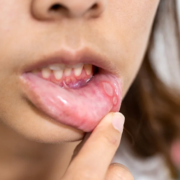 Niña con síndrome de Behçet mostrando el interior de su labio