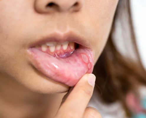 Niña con síndrome de Behçet mostrando el interior de su labio