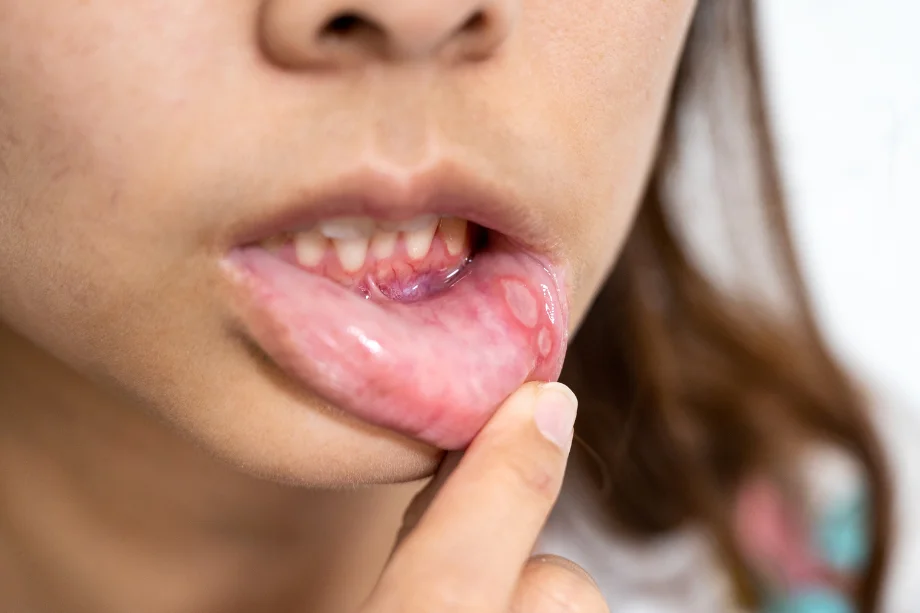 Niña con síndrome de Behçet mostrando el interior de su labio