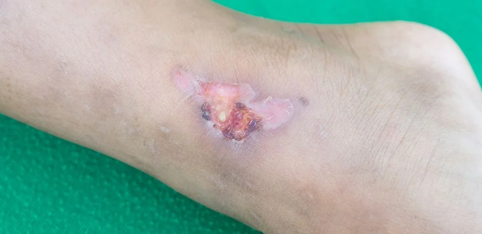 pierna con celulitis ulcerosa, mostrando una herida abierta e inflamada