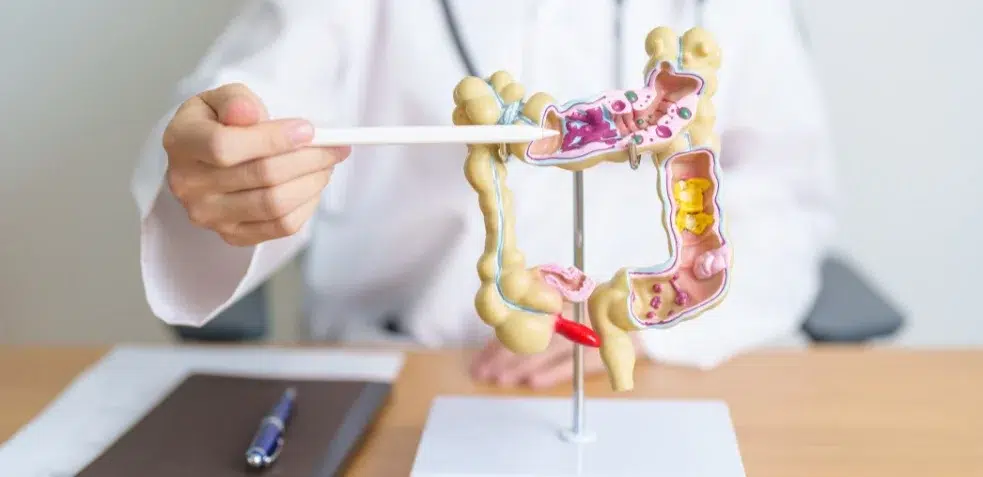 Persona con dolor abdominal agudo sosteniéndose el estómago, representando síntomas de colitis ulcerosa