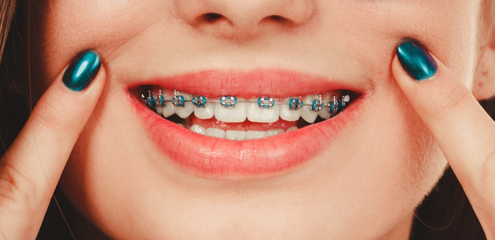 Mujer sonriendo con brackets de colores