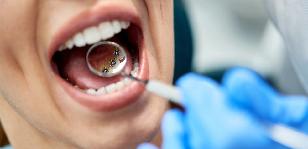 Dentista observando la boca de una mujer que tiene brackets linguales