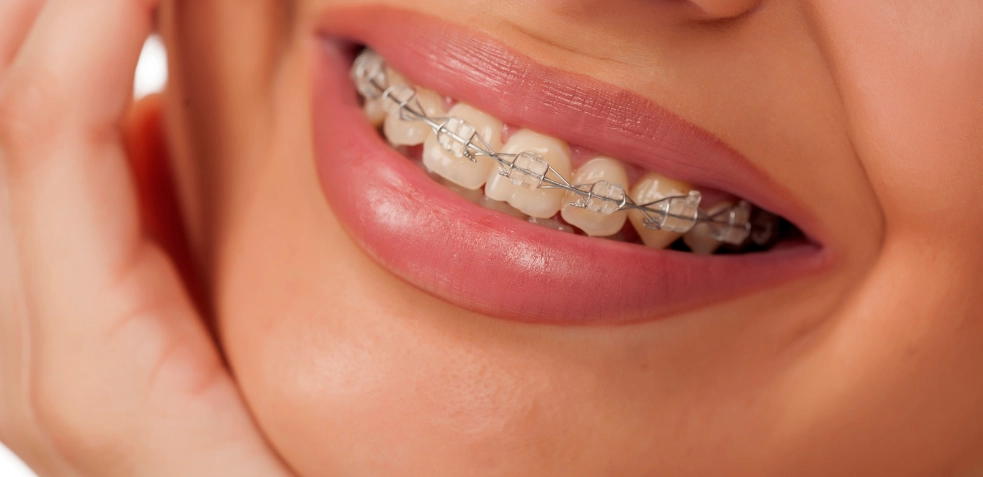 Mujer con brackets de porcelana