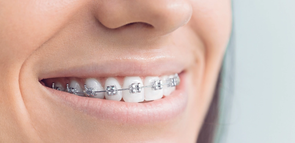 Mujer con brackets sonriendo