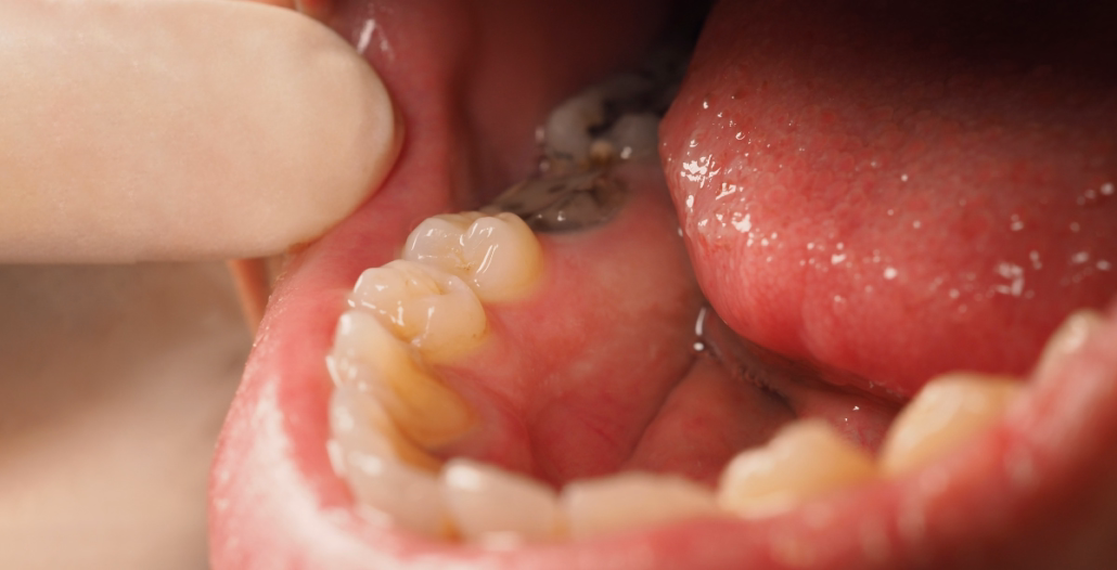 Boca abierta mostrando dientes con caries