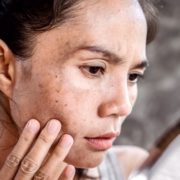 sintomas-insolacion-como-tratarla