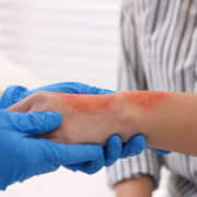 sintomas-insolacion-como-tratarla