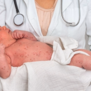 sintomas-insolacion-como-tratarla