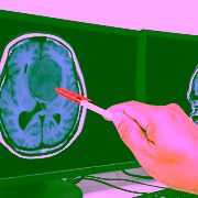 sintomas-insolacion-como-tratarla