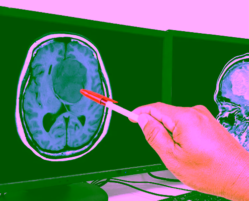 Médico examinando una resonancia cerebral con meningioma
