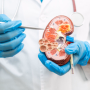 sintomas-insolacion-como-tratarla