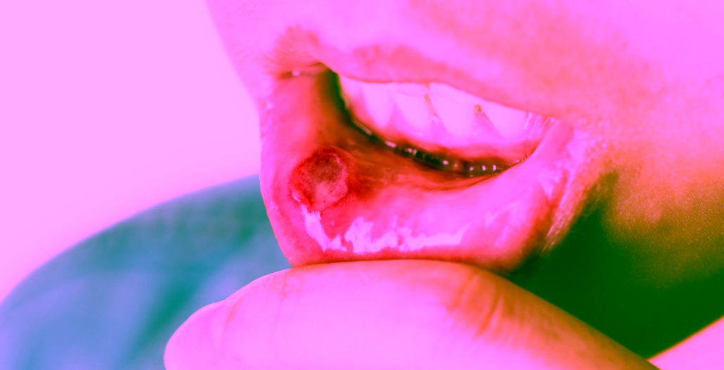 Lesión en la boca causada por herpangina