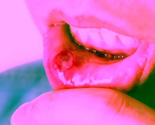 Lesión en la boca causada por herpangina