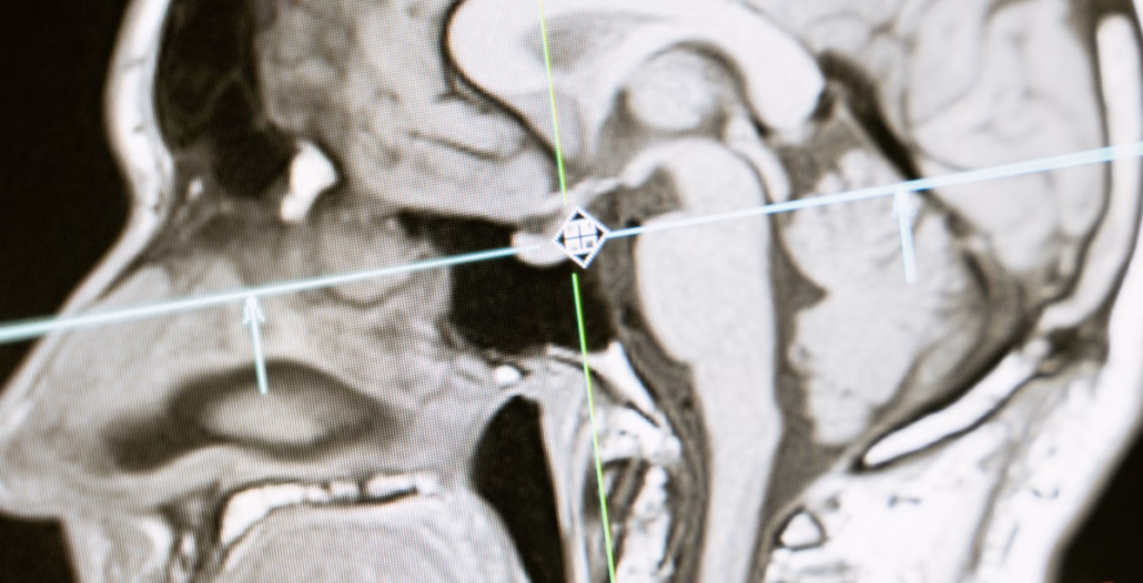 Ilustración radiológica de la hipófisis y su ubicación en el cerebro
